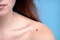 Azon bőrnövedékeket