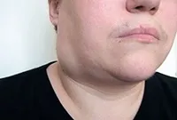 Azon bőrnövedékeket