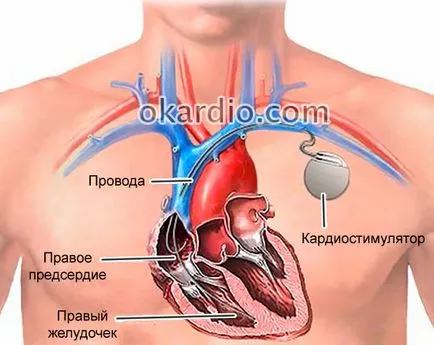 Zavarának intraventrikulas a szív, hogy ez (intraventikuláris) Zavarának intraventrikulas a szív, hogy ez