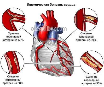 Zavarának intraventrikulas a szív, hogy ez (szív) Zavarának intraventrikulas a szív, hogy ez