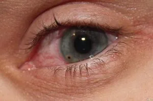 Nem eltávolított eyewinker hogyan kell eltávolítani, mit kell tennie, ha a kár a szem idegen tárgyak