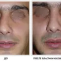 Működés rhinoseptoplasty árak orr, fotók, videók, vélemények (üzemi) Működés rhinoseptoplasty orr árak, fotók, videók, vélemények