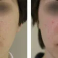 Működés rhinoseptoplasty árak orr, fotók, videók, vélemények (orr) Működés rhinoseptoplasty orr árak, fotók, videók, vélemények