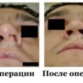 Működés rhinoseptoplasty árak orr, fotók, videók, vélemények (rhinoseptoplasty) Működés rhinoseptoplasty orr árak, fotók, videók, vélemények