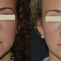 Működés rhinoseptoplasty árak orr, fotók, videók, vélemények (rhinoseptoplasty) Működés rhinoseptoplasty orr árak, fotók, videók, vélemények