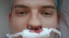 Működés rhinoseptoplasty árak orr, fotók, videók, vélemények (orr) Működés rhinoseptoplasty orr árak, fotók, videók, vélemények