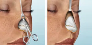 Működés rhinoseptoplasty árak orr, fotók, videók, vélemények (rhinoseptoplasty) Működés rhinoseptoplasty orr árak, fotók, videók, vélemények