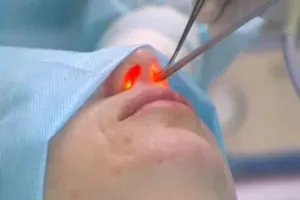 Működés rhinoseptoplasty árak orr, fotók, videók, vélemények (orr) Működés rhinoseptoplasty orr árak, fotók, videók, vélemények