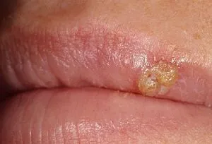 Oxolinic kenőcs herpesz az ajkakon és mennyi a kenet (oxolinic) Oxolinic kenőcs herpesz az ajkakon és mennyit kenetet