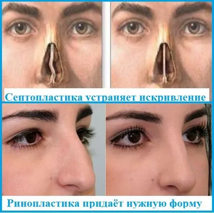 Működés rhinoseptoplasty árak orr, fotók, videók, vélemények (orr) Működés rhinoseptoplasty orr árak, fotók, videók, vélemények