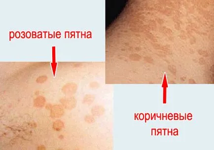 Pityriasis (többszínű) ótvar okai, tünetei, kezelése