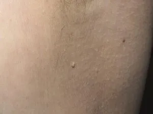 papilloma Body