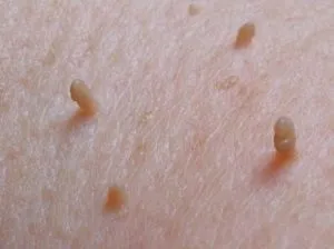 papilloma Body