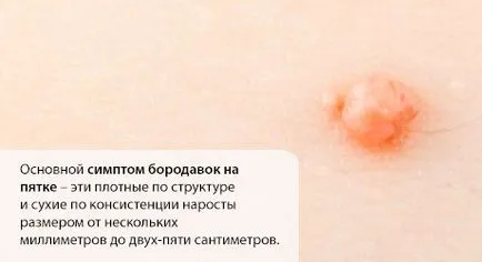 Papillomavírus különböző testrészek okozza a megjelenését, eltávolítása módszerek, fotók