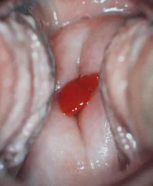 A placenta polip kezelés
