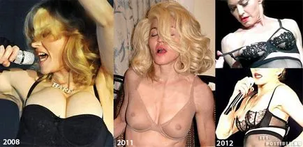 Madonna Plastic Surgery