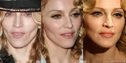 Madonna Plastic Surgery