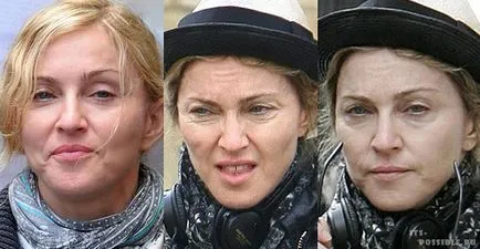 Madonna Plastic Surgery