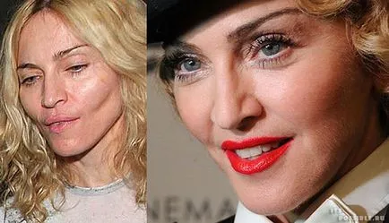 Madonna Plastic Surgery