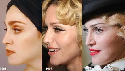 Madonna Plastic Surgery