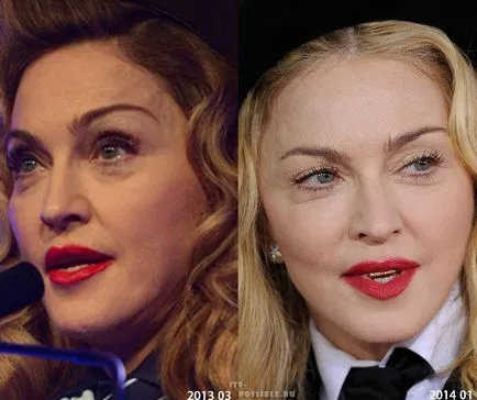 Madonna Plastic Surgery