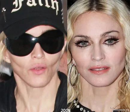 Madonna Plastic Surgery