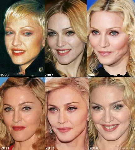Madonna Plastic Surgery