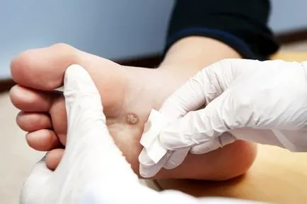A talpi szemölcsök, okai, amelyek megjelennek (ek) Talpi szemölcsök okai vannak a megjelenő