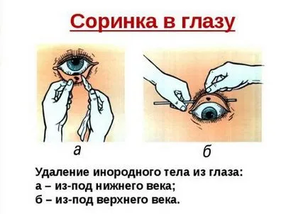 Kaptam egy porszem a szemben elsősegély