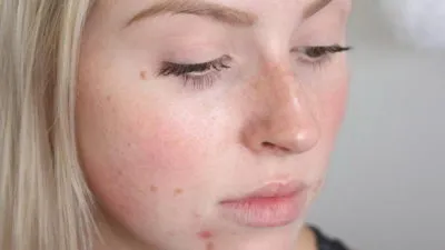Pattanások menstruáció előtt okai
