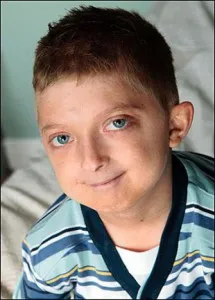 Progeria (Hutchinson-Gilford szindróma) - a betegség, amely hozza az élet a Progeria (Hutchinson-Gilford szindróma) - a betegség, amely hozza az élet a „gyors előre” portálon