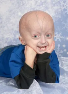 Progeria (Hutchinson-Gilford szindróma) - a betegség, amely hozza az élet a Progeria (Hutchinson-Gilford szindróma) - a betegség, amely hozza az élet a „gyors előre” portálon