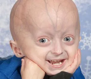 Progeria jelei progeria és leírás