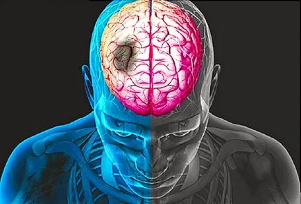 Rehabilitáció után a stroke, az alapvető szabályok