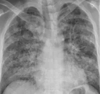 Respiratory Distress Syndrome - okai, tünetei, diagnózis és kezelés (ok) Respiratory Distress Syndrome - okai, tünetei, diagnózisa és kezelése