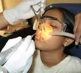 Rhinoseptoplasty endoszkópos lézer