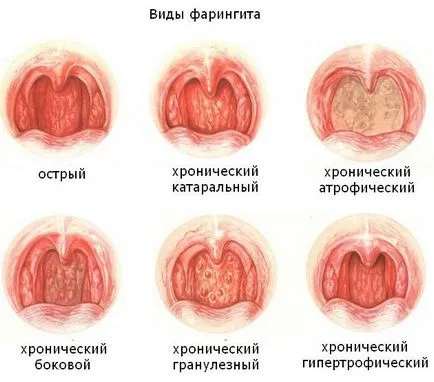 Tünetei és kezelése pharyngitis gyermekek akut, vírusos, granulosa, krónikus, képet (pharyngitis gyermekek tünetei fotó) Tünetei és kezelése pharyngitis gyermekek akut, vírusos, granulosa, krónikus, fotók