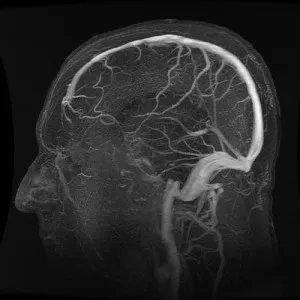 A cerebrovaszkuláris sclerosis jelek, tünetek, kezelések és megelőzési (hajók) Sclerosis, agyi érrendszeri jelek, tünetek, kezelése és megelőzése