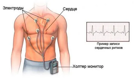 Sinus arrhythmia a szív okoz, diagnózis és kezelés (oka) Sinus arrhythmia a szív okoz, diagnosztizálására és kezelésére