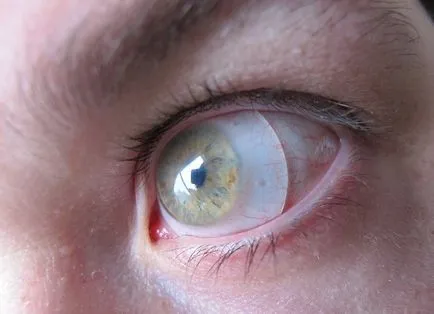 Szemfehérje lencse oktatás a használata a fotó (hogy nedvesség) Szemfehérje objektív kezelési használatáról szóló képek