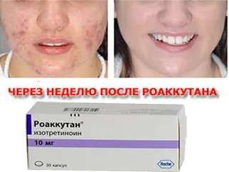Hogyan lehet gyógyítani akne Hogyan lehet gyógyítani akne