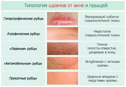 Hogyan lehet gyógyítani akne Hogyan lehet gyógyítani akne