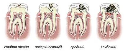 Lépés fogszuvasodás mértéke a betegség kialakulását és jellemzőit (fejlesztési) Lépés a fogszuvasodás mértéke a betegség kifejlődését és azok jellemzői