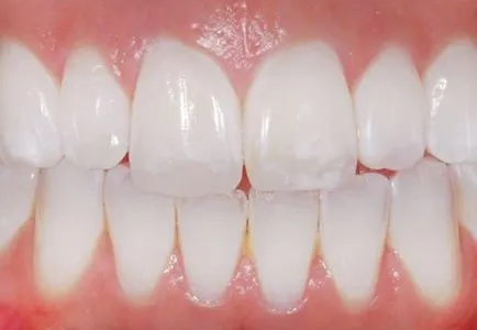 Lépés caries fejlettségi fokát a betegség és azok jellemzői (fogszuvasodás) Lépés a fogszuvasodás mértéke a betegség kifejlődését és azok jellemzői
