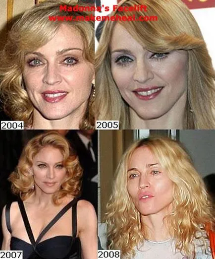 Szakértők becslése plasztikai sebészet Madonna toyboy88 blogger a helyszínen június 24, 2011,