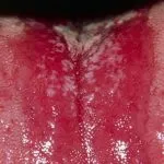 Stomatitis csecsemők különböző betegségek, a tünetek, a kezelés