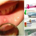 Stomatitis csecsemők különböző betegségek, a tünetek, a kezelés