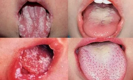 Stomatitis csecsemők különböző betegségek, a tünetek, a kezelés