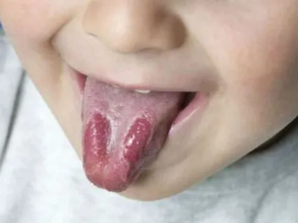 Stomatitis csecsemők különböző betegségek, a tünetek, a kezelés