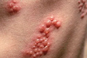 Tinea versicolor tabletták férfi